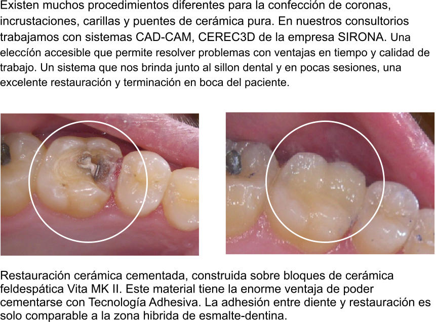 Existen muchos procedimientos diferentes para la confeccin de coronas, incrustaciones, carillas y puentes de cermica pura. En nuestros consultorios trabajamos con sistemas CAD-CAM, CEREC3D de la empresa SIRONA. Una eleccn accesible que permite resolver problemas con ventajas en tiempo y calidad de trabajo. Un sistema que nos brinda junto al sillon dental y en pocas sesiones, una excelente restauracin y terminacin en boca del paciente.               Restauracin cermica cementada, construida sobre bloques de cermica feldesptica Vita MK II. Este material tiene la enorme ventaja de poder cementarse con Tecnologa Adhesiva. La adhesin entre diente y restauracin es solo comparable a la zona hibrida de esmalte-dentina.